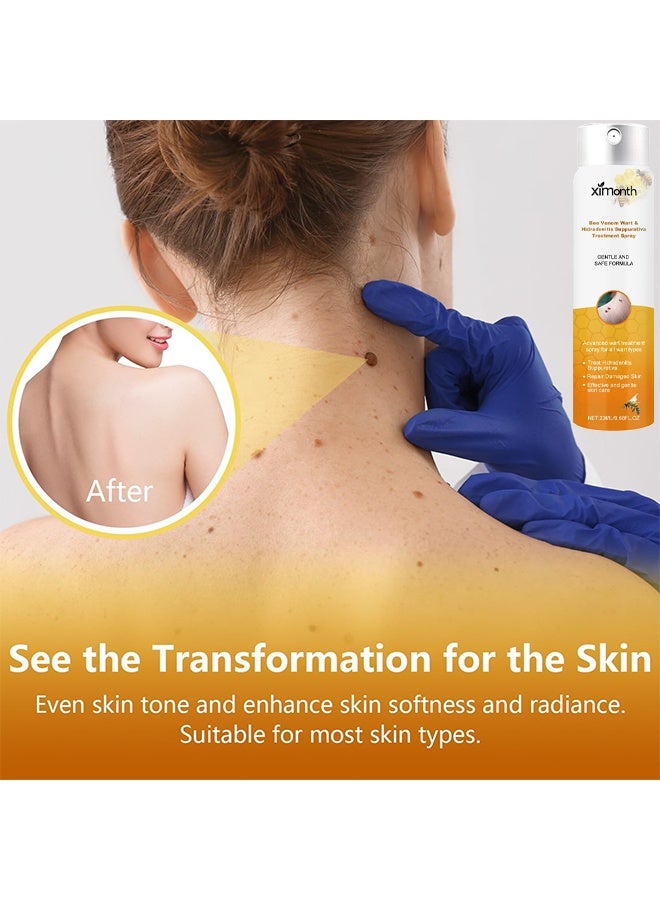 ximonth Bee Venom Wart Removal Spray, Bee Venom Wart Removal Solution, Wart Removal Freezer, Wart Removal Spray, Skin Tag Removal, Painless Removal Of Skin Tags And Moles 20ml - Image 2